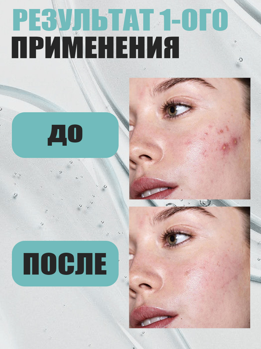 Гель для умывания Eden Stop Acne от прыщей 150мл - в интернет-магазине tut-beauty.by